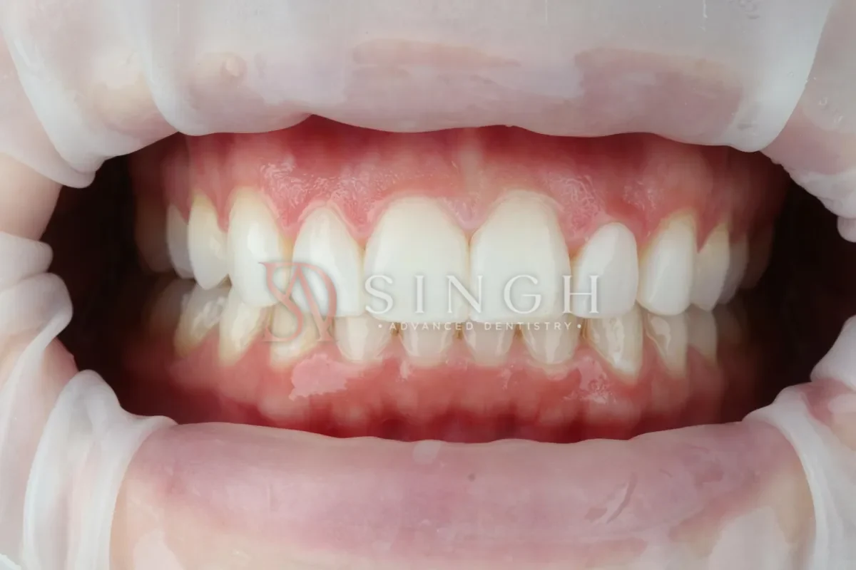 After composite veneers / resin bonding: Composite bonding to reshape and even out the front teeth.