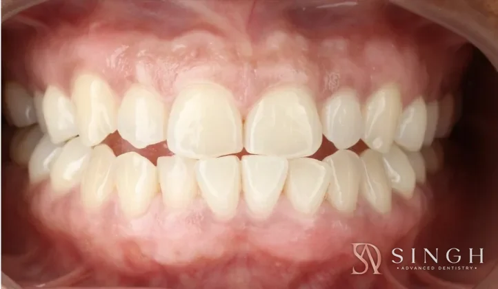 After gum depigmentation: Laser gum depigmentation to even out darker gum colour.
