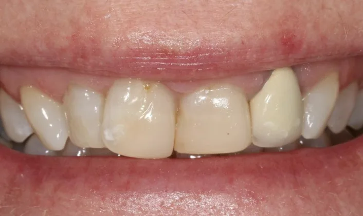 Before veneers