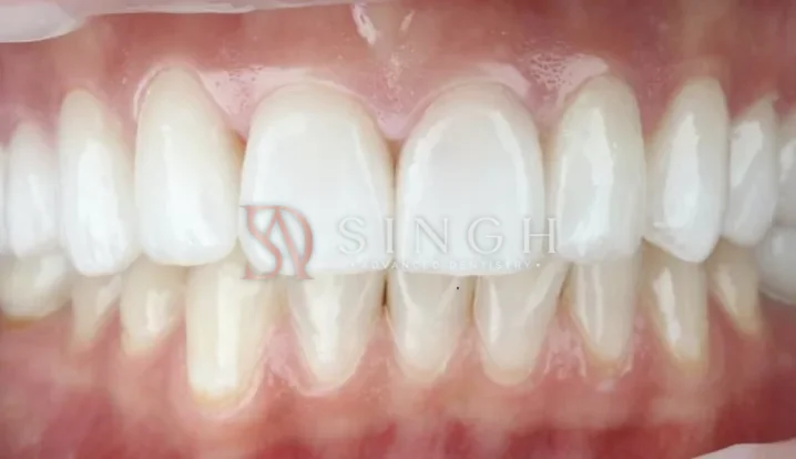 After veneers: Porcelain veneers to replace discoloured, uneven front teeth.