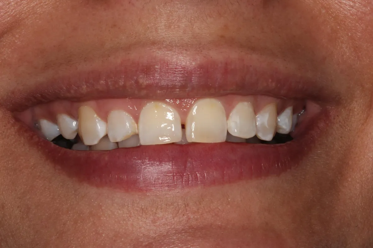 Before composite veneers / resin bonding