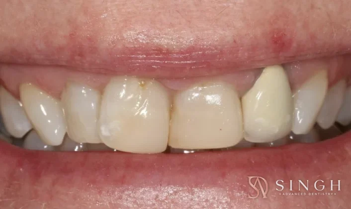 Before veneers