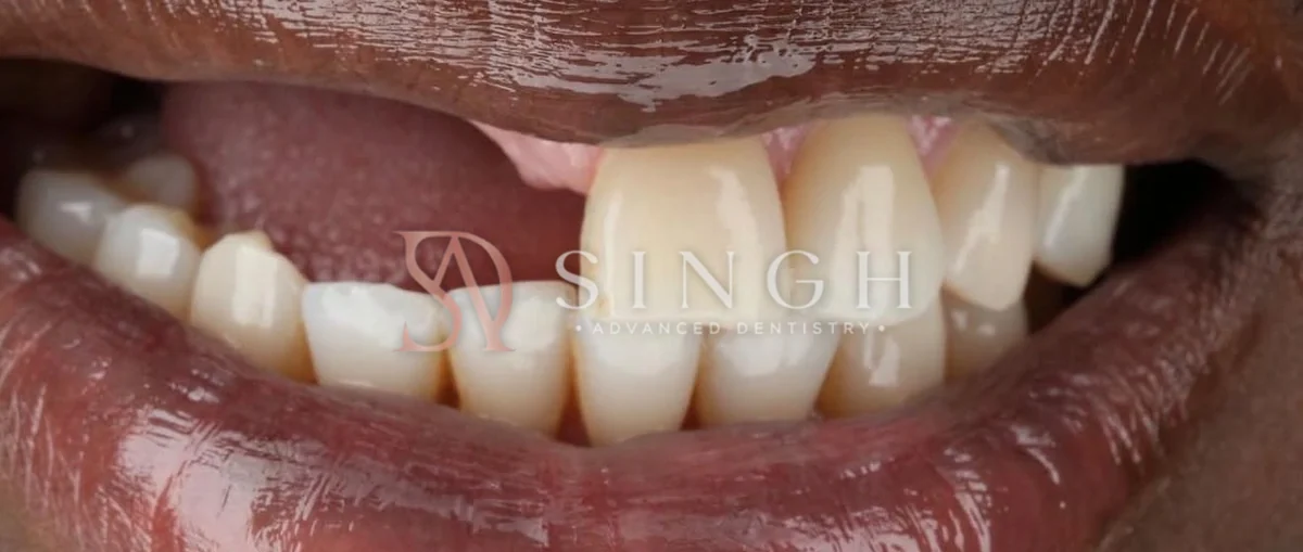 Before: A flexible partial denture to replace missing upper front teeth.