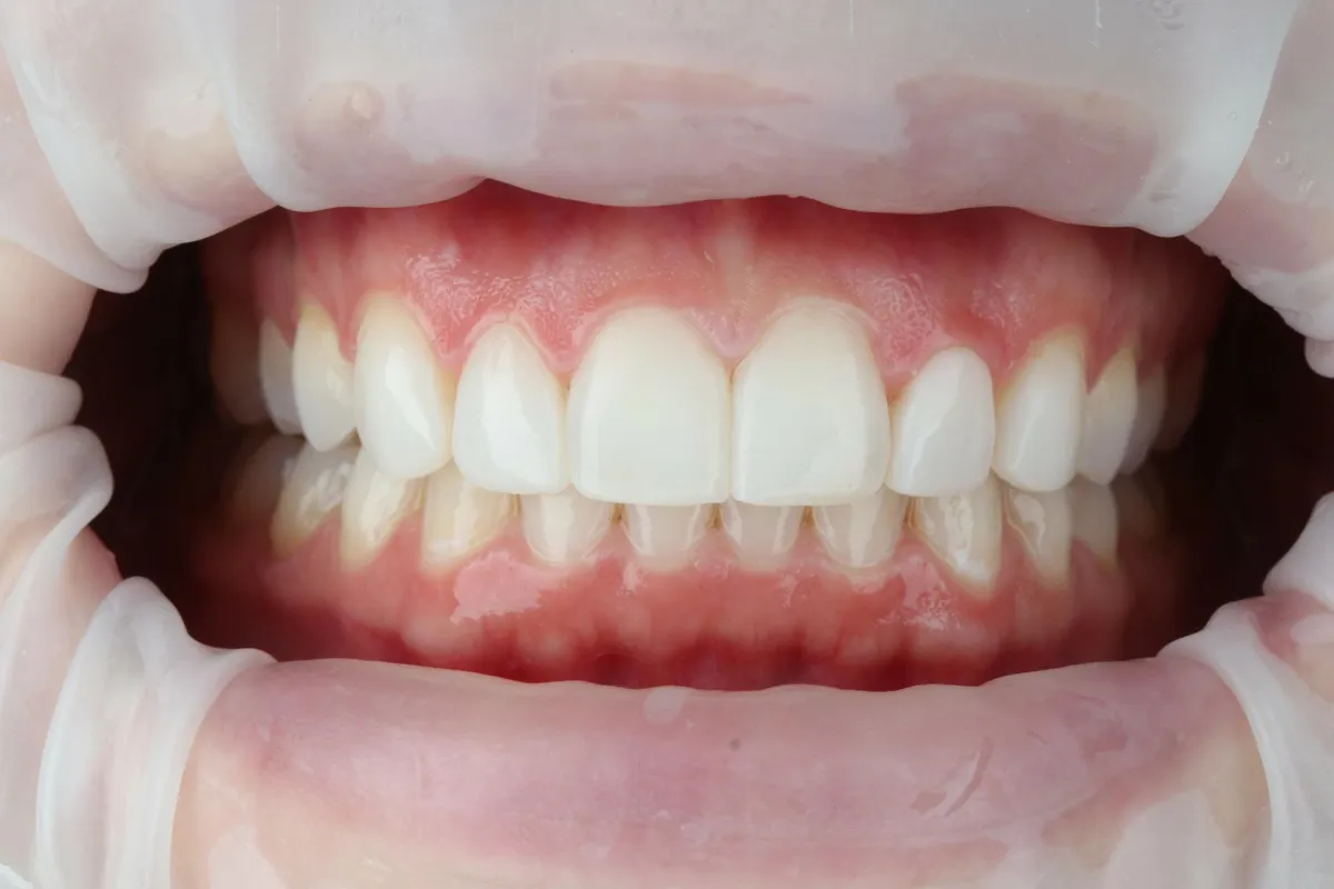 After composite veneers / resin bonding: Composite bonding to reshape and even out the front teeth.