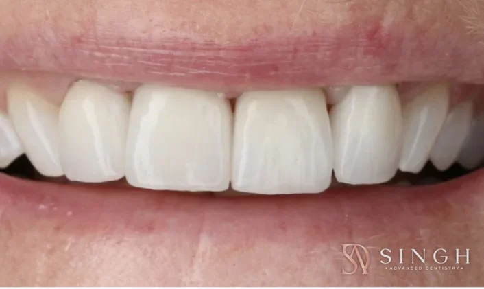 After veneers: Porcelain veneers to brighten and even out the front teeth.