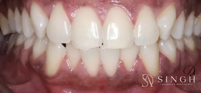 After whitening: Professional in-chair whitening.