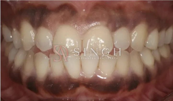 Before gum depigmentation