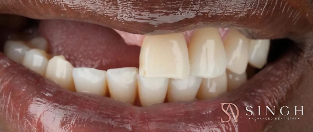 Before dentures