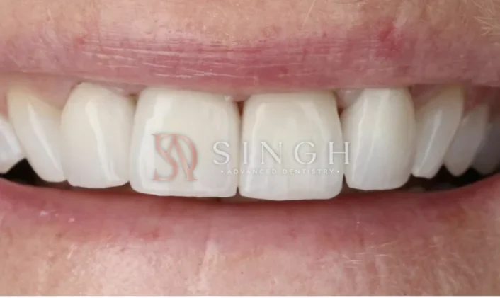 After veneers: Porcelain veneers to brighten and even out the front teeth.