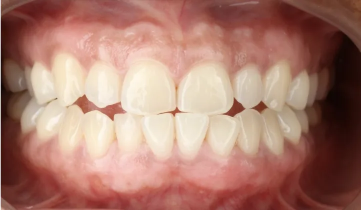 After gum depigmentation: Laser gum depigmentation to even out darker gum colour.
