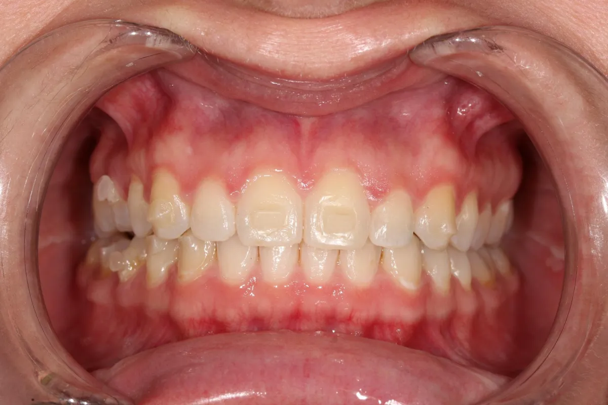 Before composite veneers / resin bonding