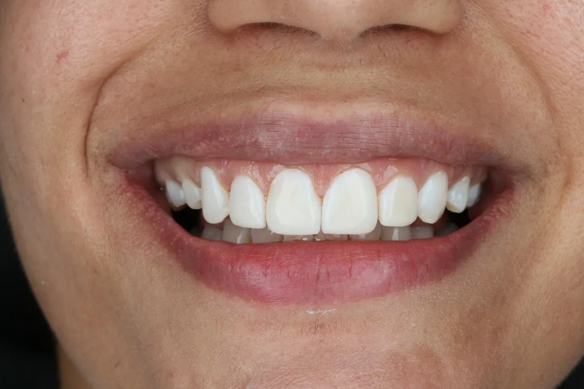 After composite veneers / resin bonding: Bonding to restore worn, uneven edges.
