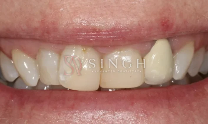 Before veneers