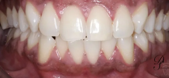 After whitening: Professional in-chair whitening.