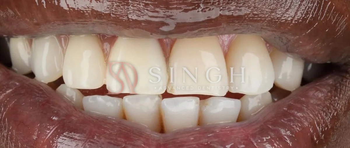 After: A flexible partial denture to replace missing upper front teeth.