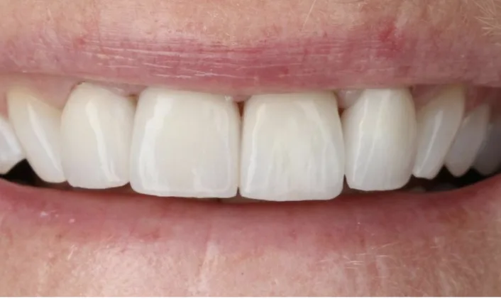 After veneers: Porcelain veneers to brighten and even out the front teeth.