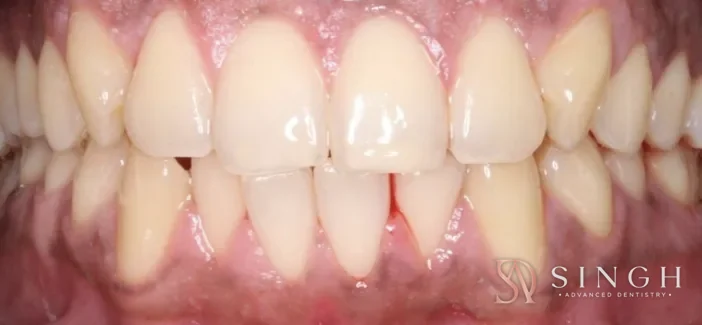 Before whitening