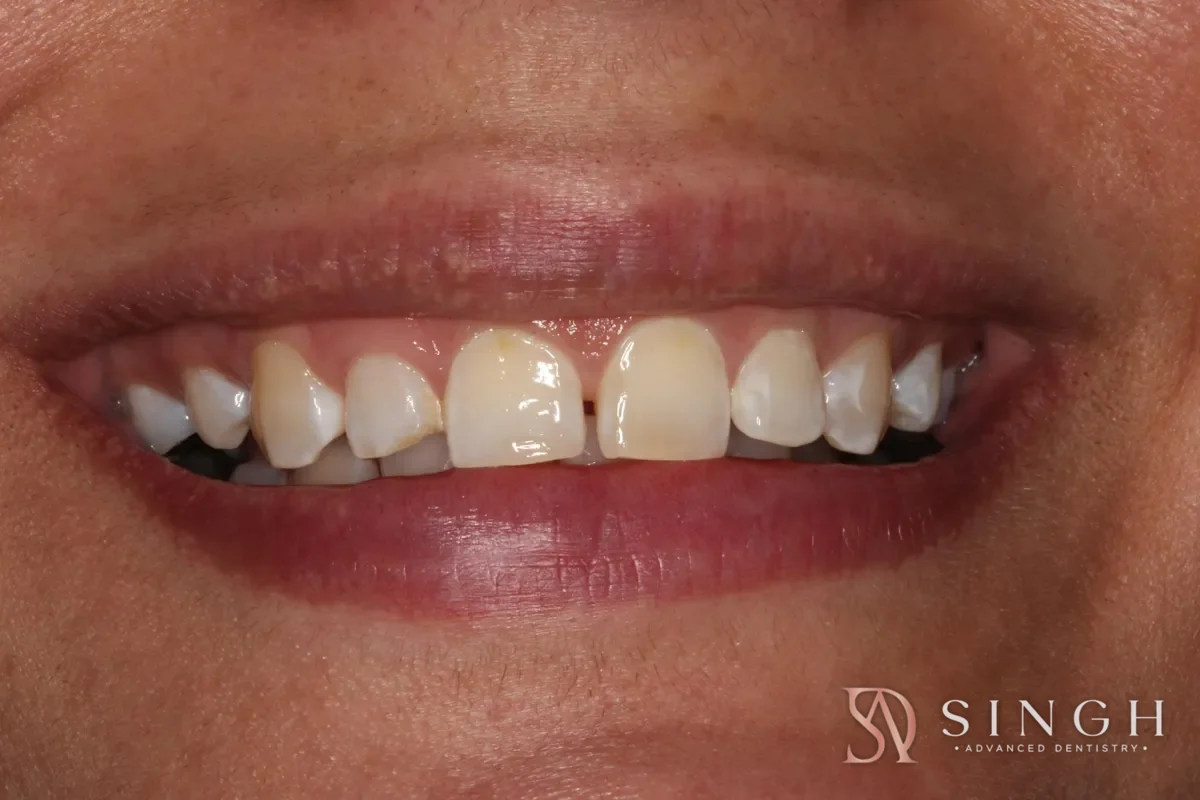 Before composite veneers / resin bonding