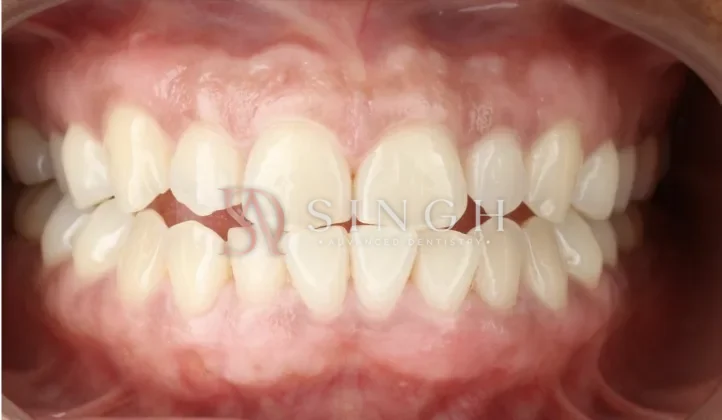 After gum depigmentation: Laser gum depigmentation to even out darker gum colour.