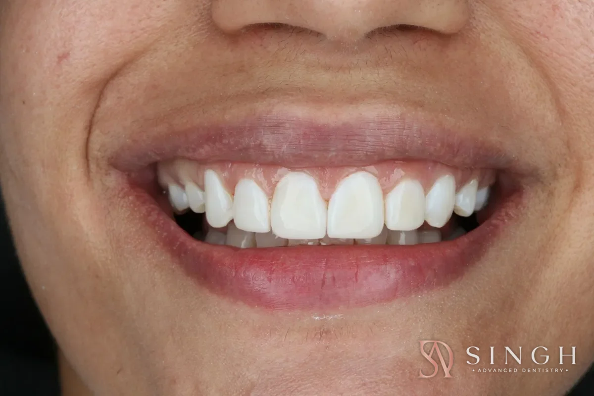 After composite veneers / resin bonding: Bonding to restore worn, uneven edges.