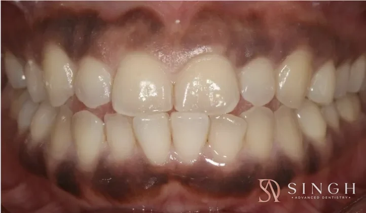 Before gum depigmentation