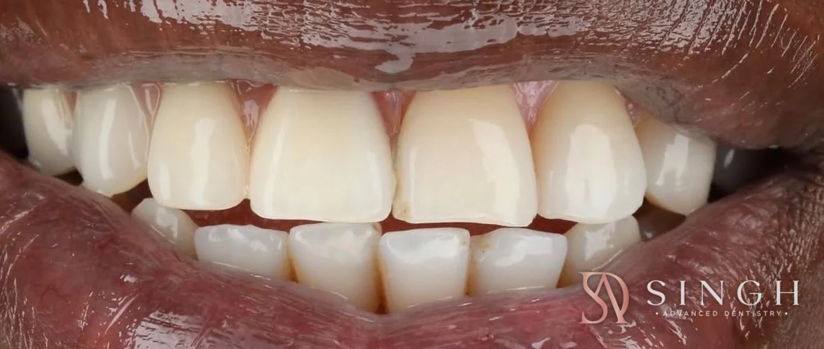 After dentures: A flexible partial denture to replace missing upper front teeth.