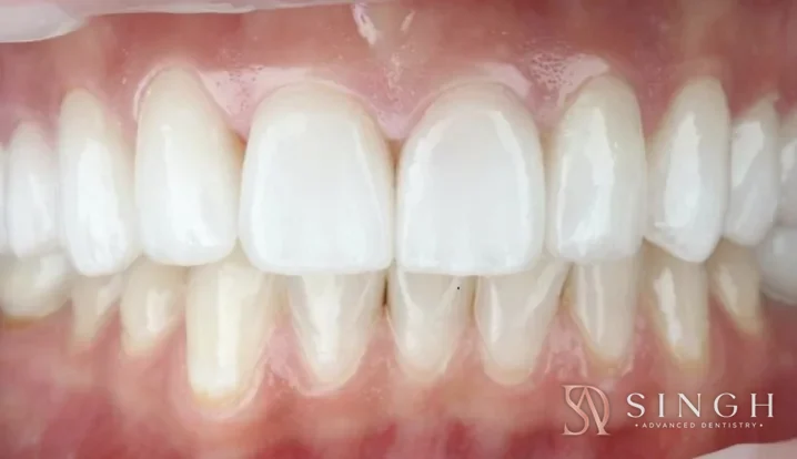 After veneers: Porcelain veneers to replace discoloured, uneven front teeth.