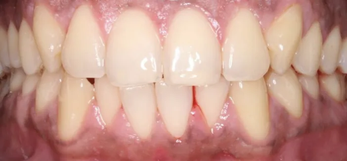 Before whitening