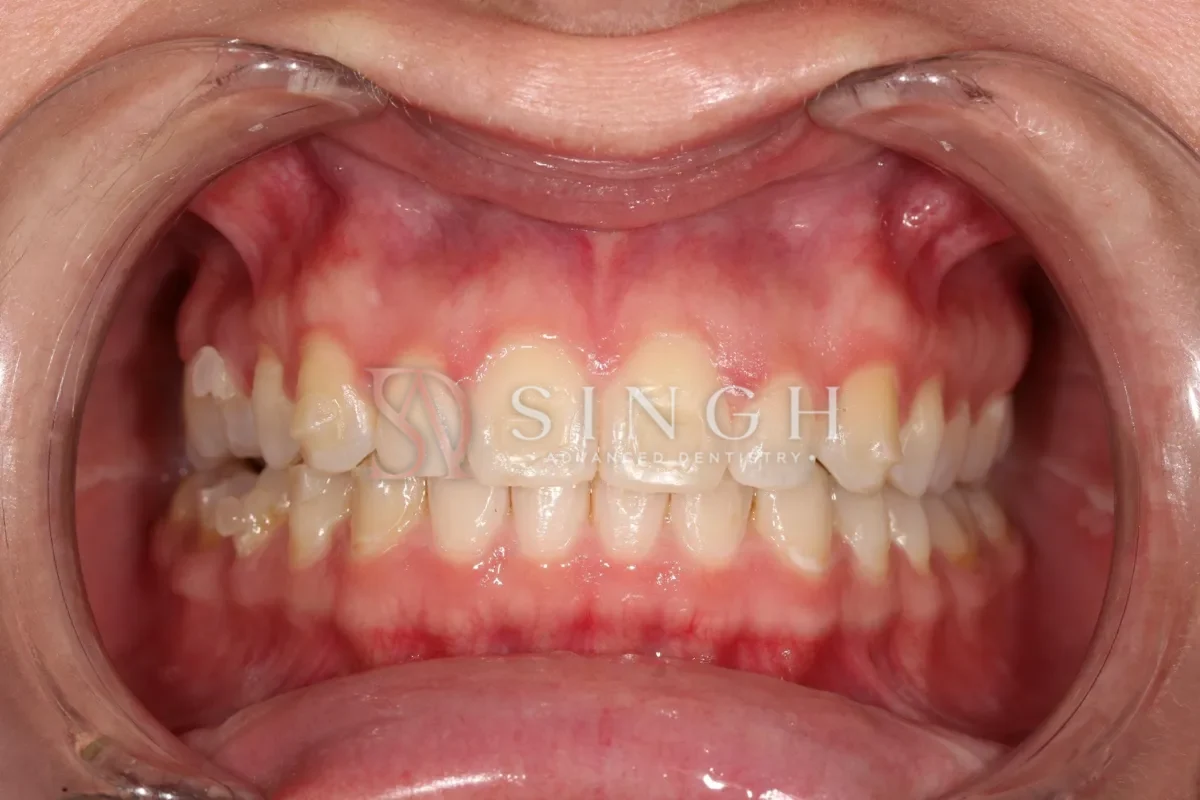 Before composite veneers / resin bonding