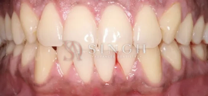 Before whitening