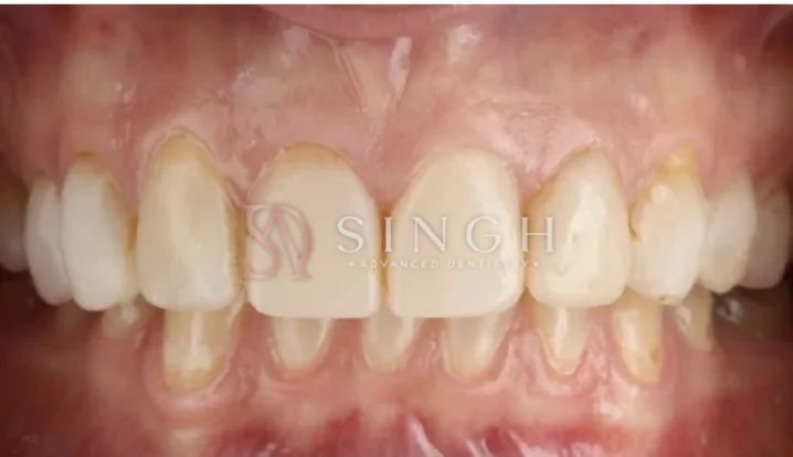 Before veneers