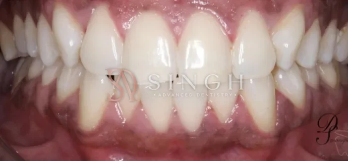 After whitening: Professional in-chair whitening.