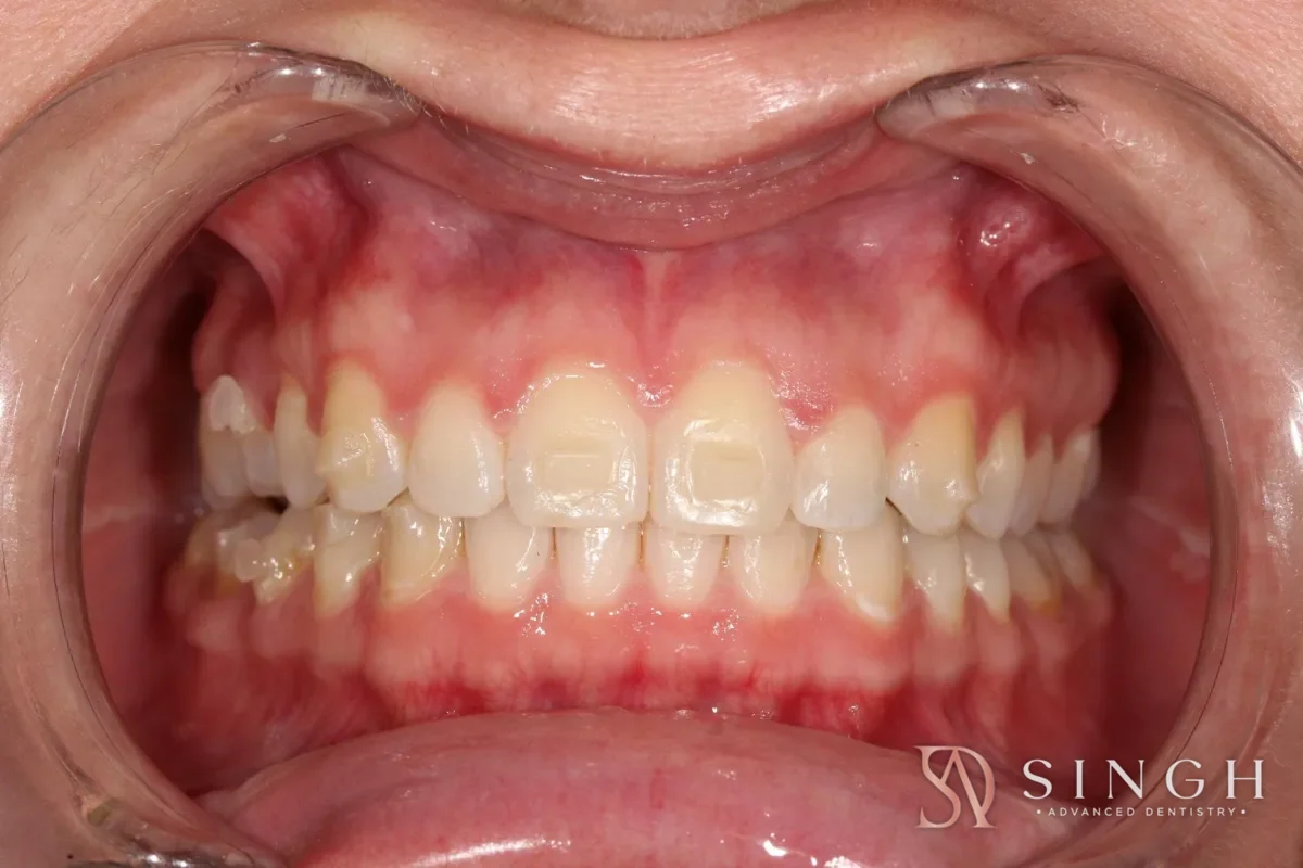 Before composite veneers / resin bonding