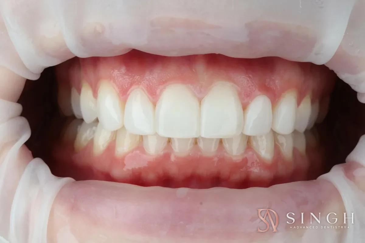 After composite veneers / resin bonding: Composite bonding to reshape and even out the front teeth.