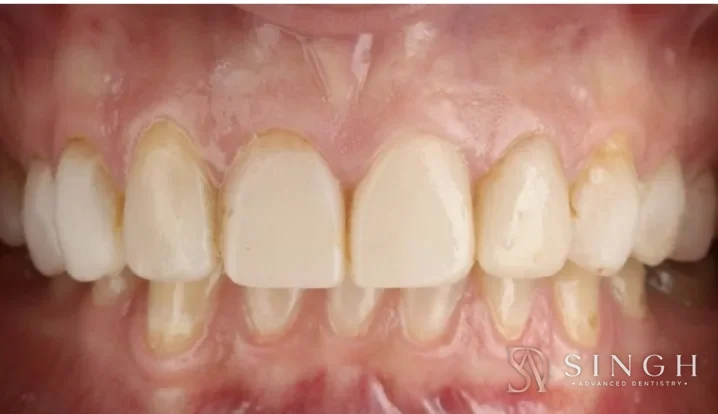Before veneers